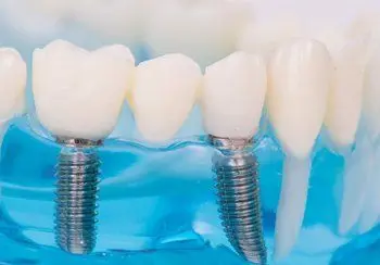 Model of crowns on implants